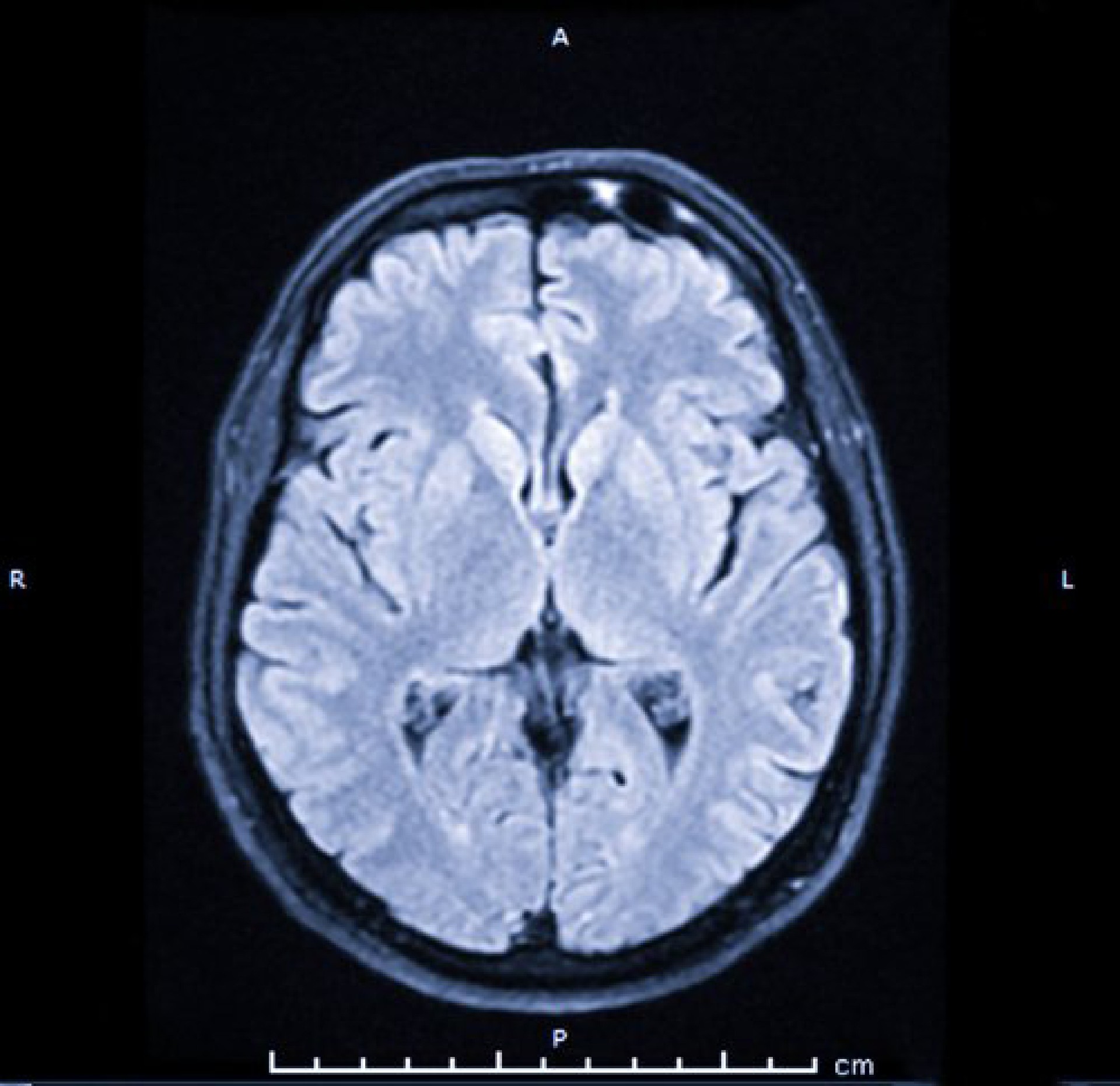 Resonancia magnética cerebral. Escaneo de la imagen de resonancia magnética del cerebro. Herramienta médica de diagnóstico